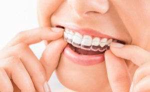 Invisalign Doctor Site